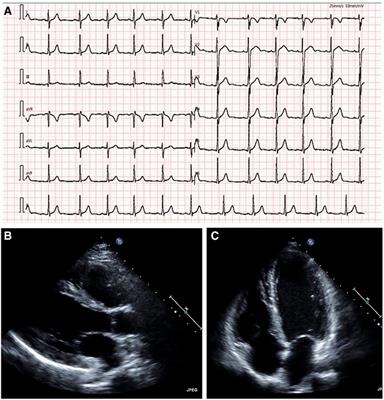 A CT-FFR-guided unroofing procedure for repairing the anomalous origin of the left coronary artery—a case report